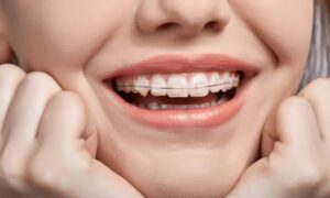 Descubre qué tipo de aparato de ortodoncia es perfecto para tu sonrisa. Ortodoncia invisible en Oviedo