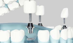 Beneficios de la Implantología Digital. Implantes dentales Oviedo