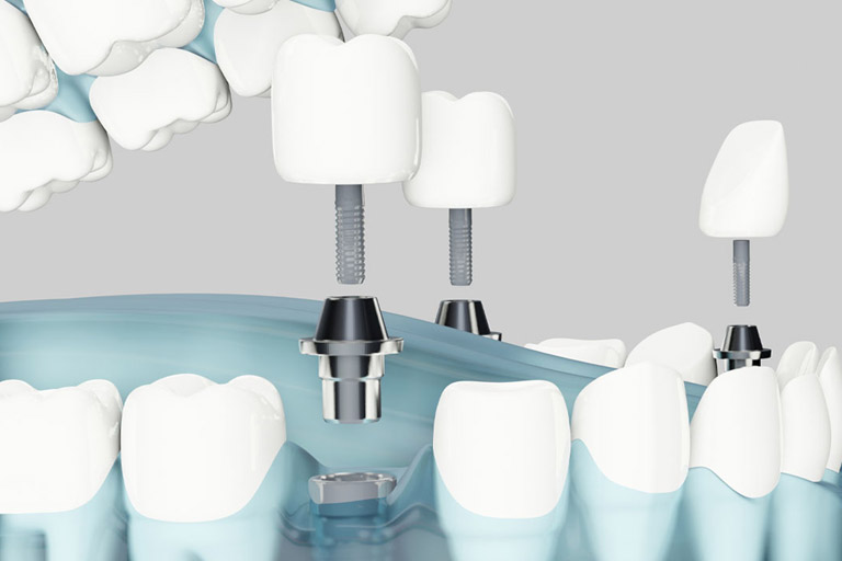 Beneficios de la Implantología Digital. Implantes dentales Oviedo