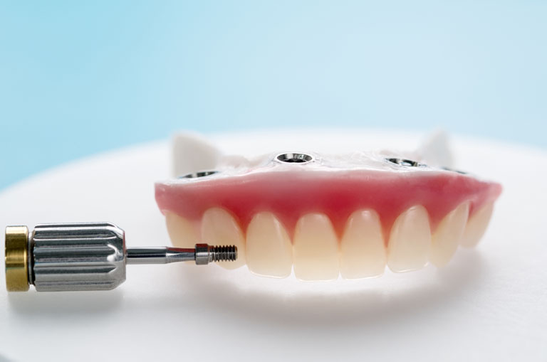 ¿EN QUÉ CONSISTE LA TÉCNICA All on Four®? Clínica Bousoño Vargas. Implantes dentales en Oviedo