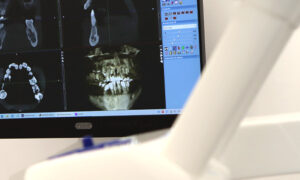 Enfermedades de las encías y su relación con los implantes dentales. Bousoño Vargas, Implantes Dentales en Oviedo.