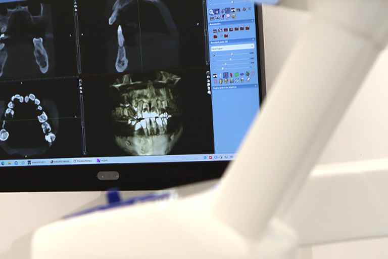 Enfermedades de las encías y su relación con los implantes dentales. Bousoño Vargas, Implantes Dentales en Oviedo.