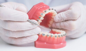Urgencias en ortodoncia: ¿Qué hacer?. Bousoño Vargas, tu clínica de ortodoncia en Oviedo.
