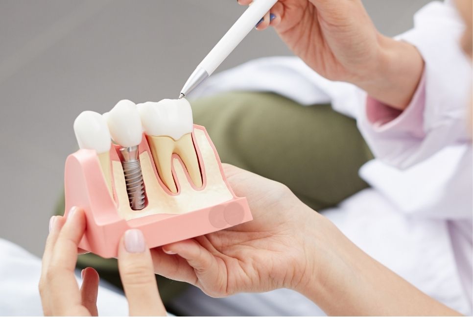 Comparativa entre implantes dentales y dentadura postiza