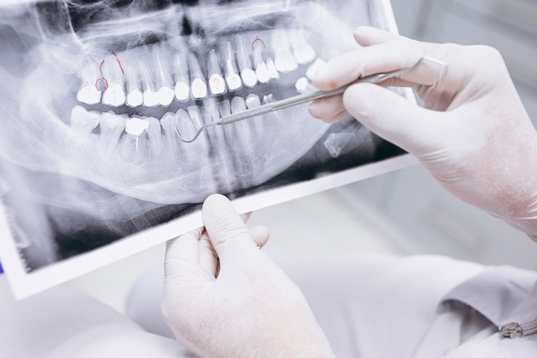Recupera tu sonrisa con implantes dentales. Bousoño Vargas, Dentista en Oviedo.