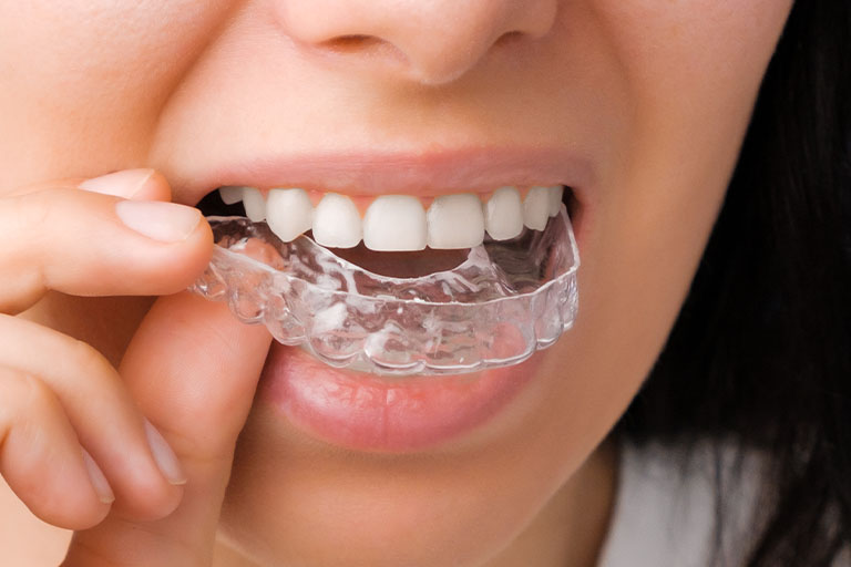 La ortodoncia en adultos, al alza. Clínica Bousoño Vargas, ortodoncia invisible en Oviedo.