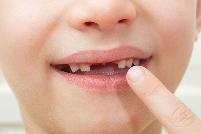 Cómo lidiar con la pérdida del primer diente de leche. Dentista en Oviedo.