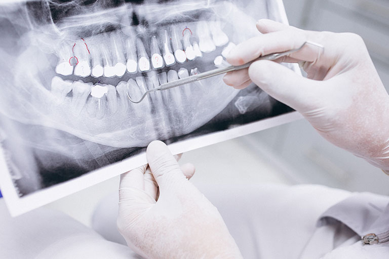 Recupera tu sonrisa con implantes dentales. Bousoño Vargas, Dentista en Oviedo.