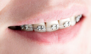 Sonrisa alineada tratada con ortodoncia en la Clínica Dental Bousoño Vargas