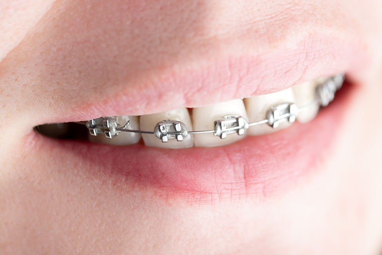 Sonrisa alineada tratada con ortodoncia en la Clínica Dental Bousoño Vargas