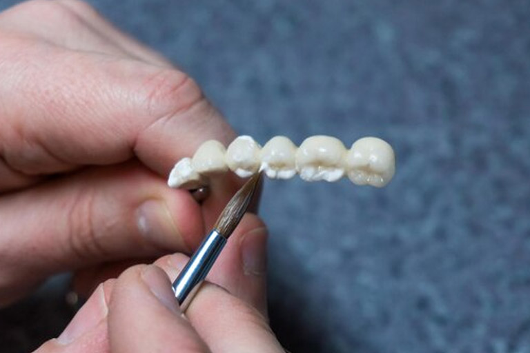 ¿Qué es mejor: prótesis o puente?. Clínica Bousoño Vargas, Implantes dentales en Oviedo