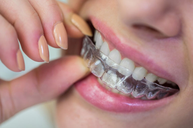 BENEFICIOS MÉDICOS DE LA ORTODONCIA - Clínica Bousoño Vargas - Ortodoncia en Oviedo