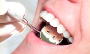 Cómo mantener limpia tu ortodoncia lingual. Ortodoncia invisible en Oviedo