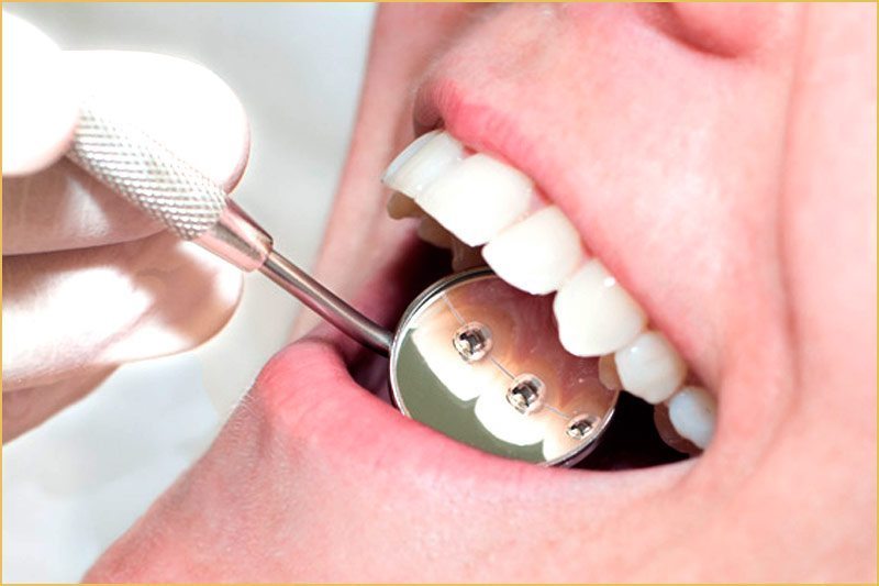 Cómo mantener limpia tu ortodoncia lingual. Ortodoncia invisible en Oviedo