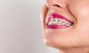 Tips para pequeños accidentes con brackets. Clínica Dental Bousoño Vargas. Ortodoncia invisible en Oviedo