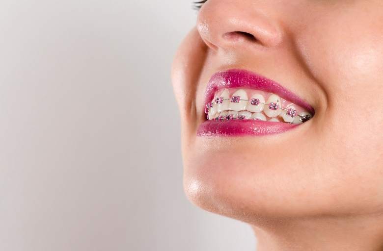 Tips para pequeños accidentes con brackets. Clínica Dental Bousoño Vargas. Ortodoncia invisible en Oviedo