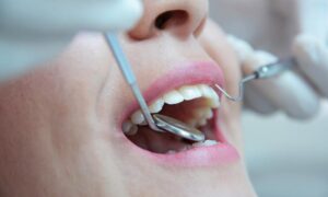 Preguntas frecuentes sobre una endodoncia. Bousoño Vargas, dentistas en Oviedo