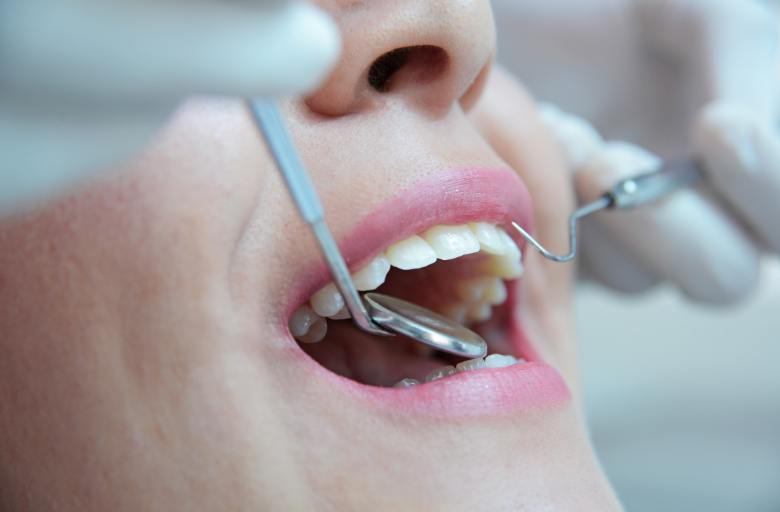 Preguntas frecuentes sobre una endodoncia. Bousoño Vargas, dentistas en Oviedo