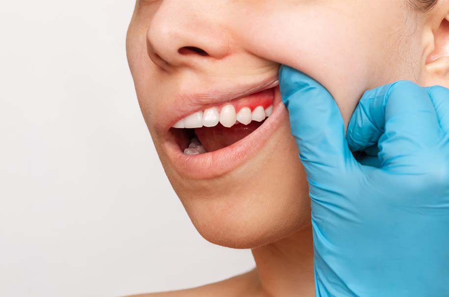 ¿Sabes qué es la cirugía estética de la encía?. Clínica Dental Bousoño Vargas. Dentista en Ovied
