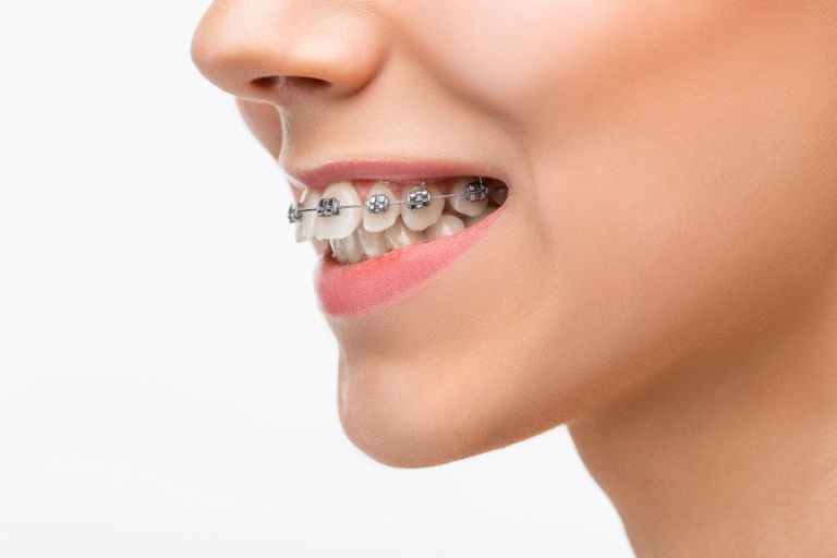 Cómo afectan los brackets en las encías - Clínica Bousoño Vargas - Ortodoncia invisible Oviedo