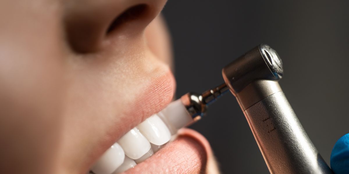 Limpieza Dental - Manchas Dentales – Solución y Cuidado - Bousoño Vargas -Dentista Oviedo