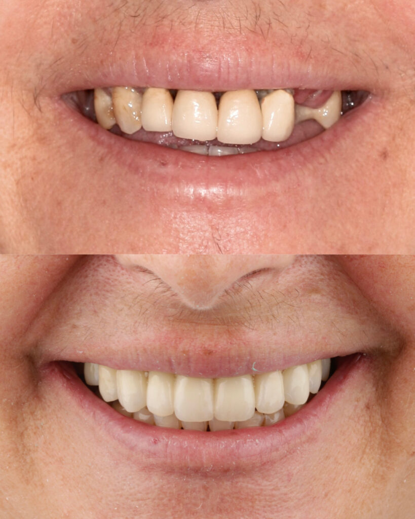 Caso de éxito rehabilitación con coronas