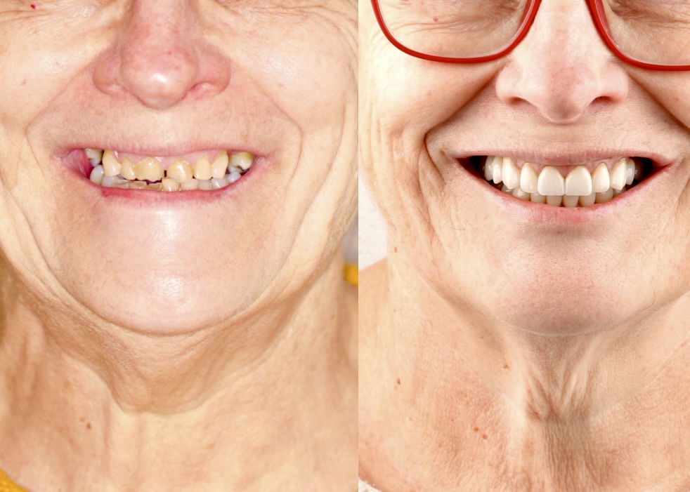 Caso de paciente de rehabilitación con coronas