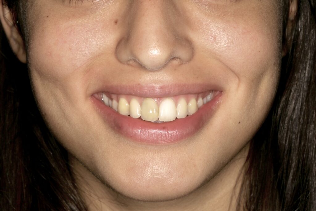 Caso antes y después de blanqueamiento dental