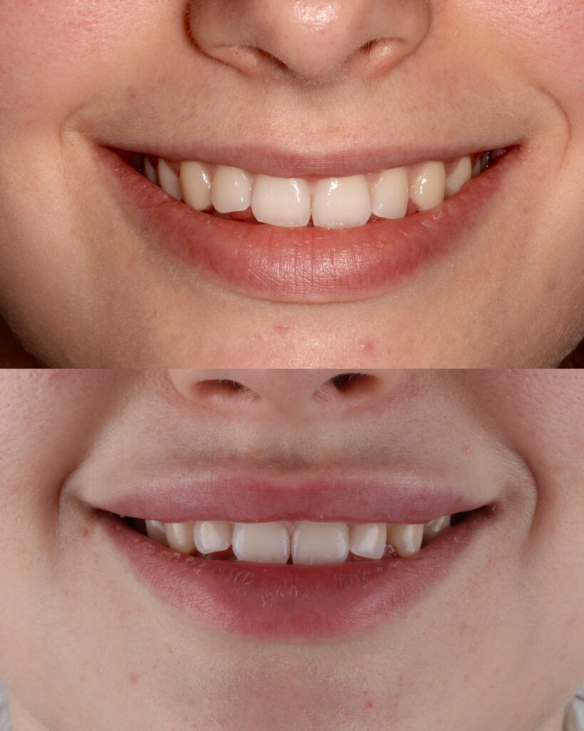 Antes y después de ácido hialurónico en Labios Oviedo