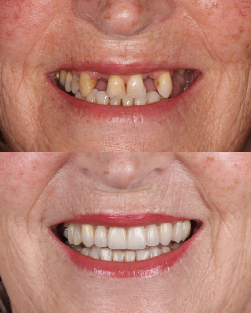 Caso de éxito prótesis sobre implantes