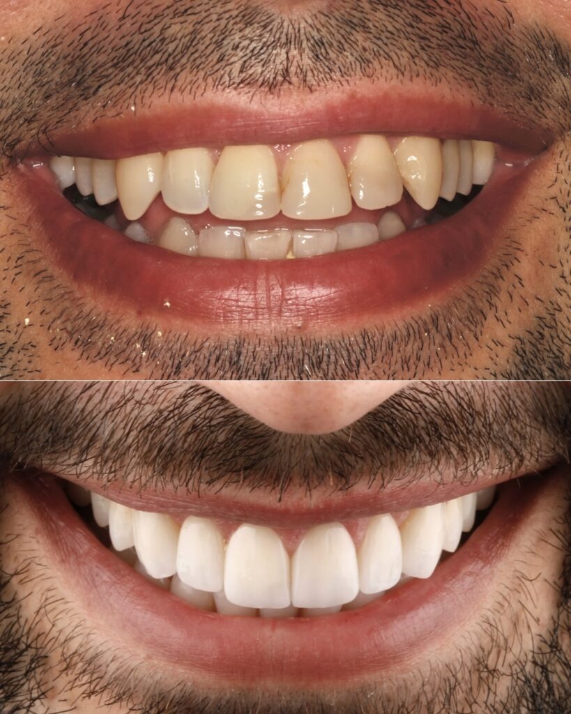 Se muestra una imagen de antes y después de carillas dentales en la cínica dental bousoño vargas