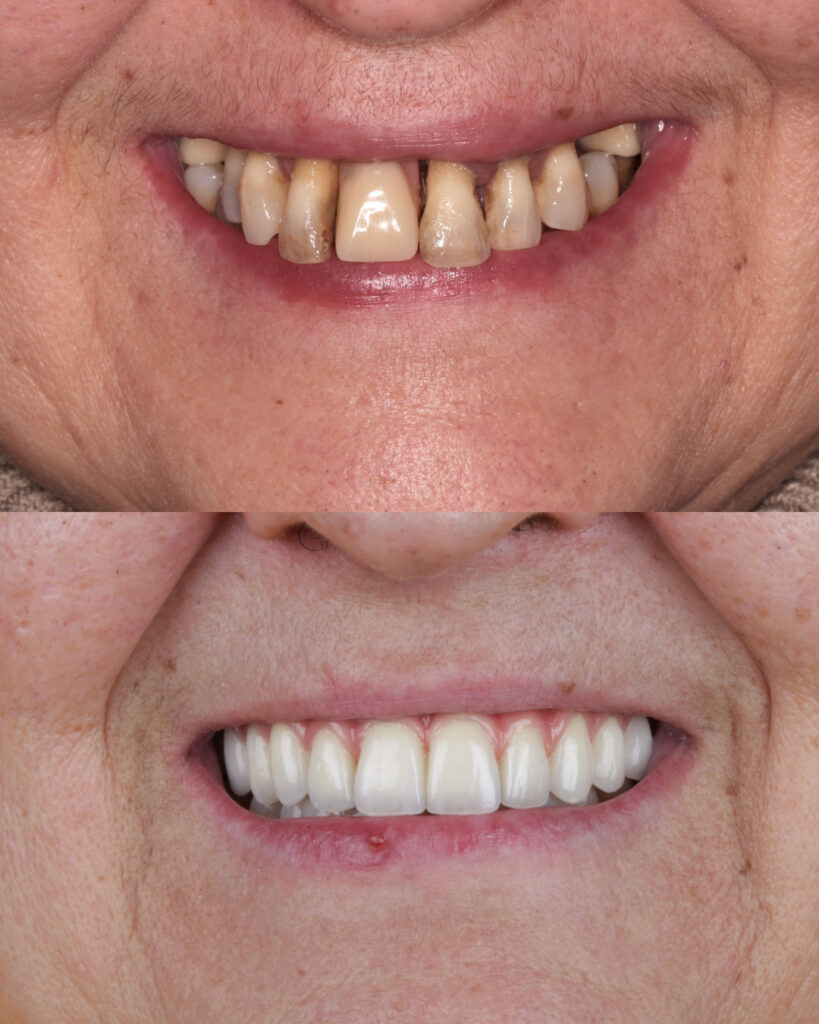 Antes y después coronas dentales