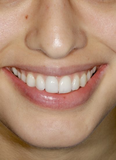 Imagen que muestra un tratamiento Post blanqueamiento dental