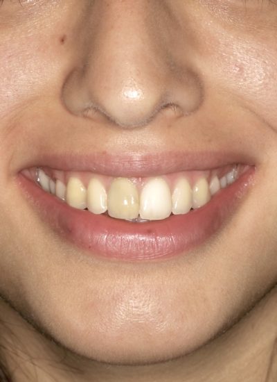Caso antes y después de blanqueamiento dental